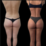 J-Plasma Innovations Offered by the Best Doctors in Dubai