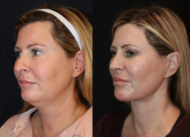 How Best Aesthetic Clinic in Dubai Transforming Skin Tightening in Dubai Procedure