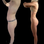 How the Best Plastic Surgeon in Dubai Enhances Skin with J-Plasma