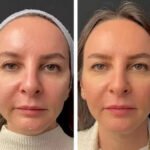 How the Best Plastic Surgeons in Dubai Use Mesotherapy for Non-Surgical Skin Rejuvenation