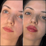 Enhance Your Look with the Best Aesthetic Clinic in dubai for Fillers