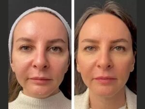 Best Aesthetic Clinic in Dubai for Trusted Mesotherapy Treatments