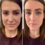 PRP Treatment in Dubai Elevating Non-Surgical Hair Care