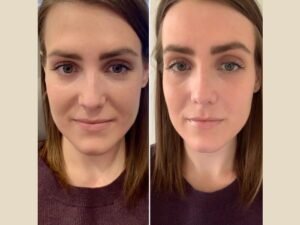 PRP Treatment in Dubai Elevating Non-Surgical Hair Care