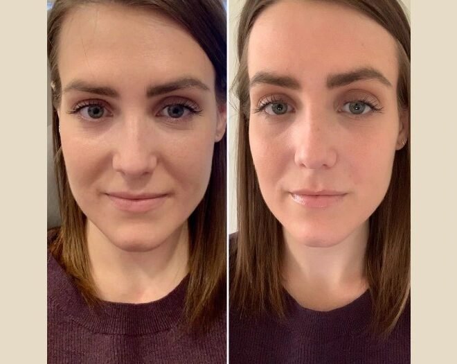 PRP Treatment in Dubai Elevating Non-Surgical Hair Care