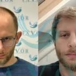 Best Hair Transplant Turkey: How to Fix a Pluggy Doll-Like Hairline