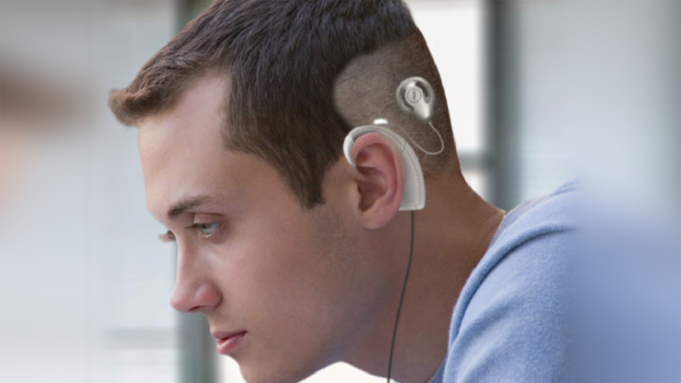 Cochlear Implant Price in Pakistan – Cost, Factors & Complete Guide (2026)