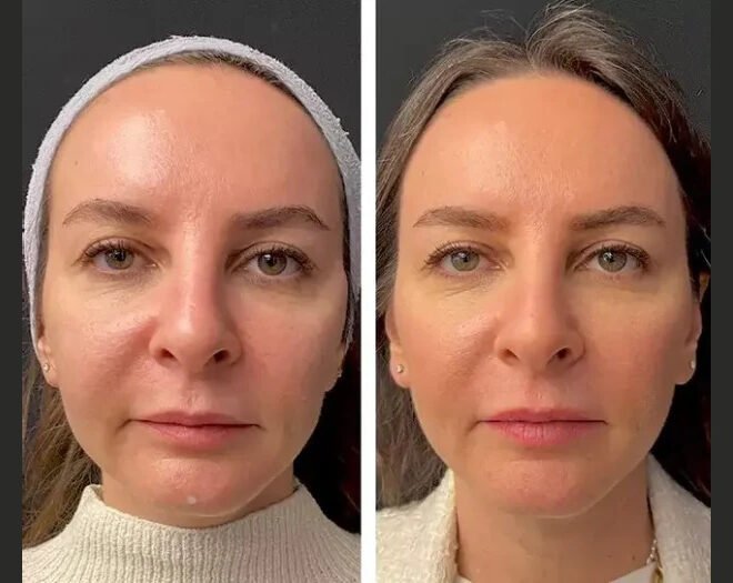 Best Plastic Surgeon in Dubai: Mesotherapy for Glowing and Youthful Skin
