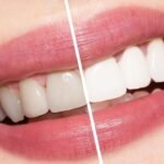 Is Teeth Whitening Painful?