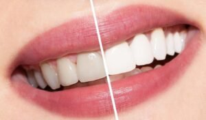 Is Teeth Whitening Painful?