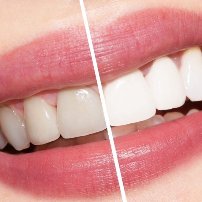Is Teeth Whitening Painful?