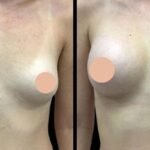 Best Breast Augmentation Surgeon in Dubai: Who Is an Ideal Candidate for Surgery