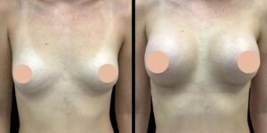Best Breast Augmentation Surgeon in Dubai: Who Is an Ideal Candidate for Surgery