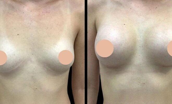 Best Breast Augmentation Surgeon in Dubai: Who Is an Ideal Candidate for Surgery