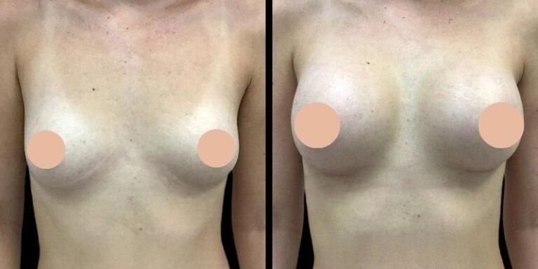 Best Breast Augmentation Surgeon in Dubai: Who Is an Ideal Candidate for Surgery