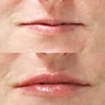 Botox & Dermal Fillers in Savannah, GA: Choosing the Right Injectable Treatment