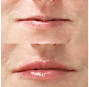 Botox & Dermal Fillers in Savannah, GA: Choosing the Right Injectable Treatment