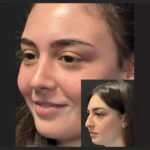 Is Nose Surgery in Dubai Suitable for Cosmetic Concerns?