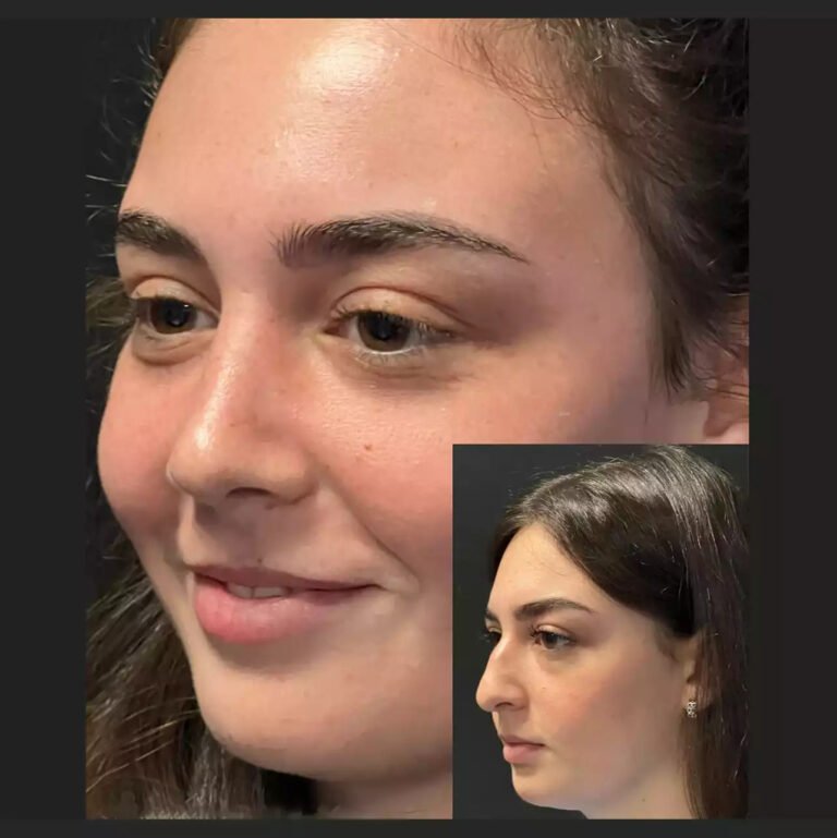 Is Nose Surgery in Dubai Suitable for Cosmetic Concerns?