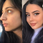 Best Rhinoplasty Surgeon in Dubai: Finding the Right Specialist