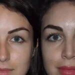 Rhinoplasty in Dubai: How to Make an Informed Surgical Decision