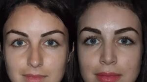 Rhinoplasty in Dubai: How to Make an Informed Surgical Decision