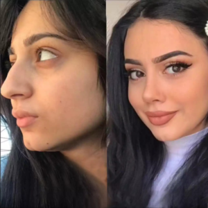 Best Rhinoplasty Surgeon in Dubai: Finding the Right Specialist