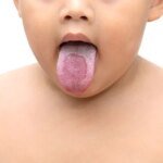 White Patch on Tongue That Won’t Go Away