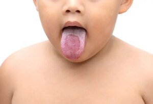 White Patch on Tongue That Won’t Go Away