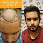 Best Hair Transplant in Gurgaon: How to Choose the Right Clinic and Treatment