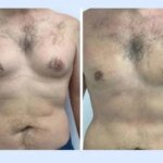Best Gynecomastia Surgeon in Dubai and the Importance of Individualized Surgical Care