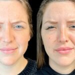 Botox for Anti-Aging with the Best Plastic Surgeons in dubai