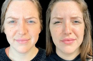 Botox for Anti-Aging with the Best Plastic Surgeons in dubai