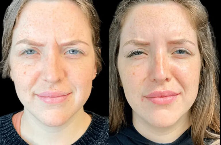 Botox for Anti-Aging with the Best Plastic Surgeons in dubai