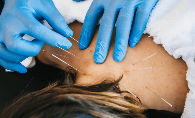 FYZICAL Therapy and Balance Centers – Hickory Flat: How Dry Needling in Woodstock Can Support Muscle Recovery and Better Movement?