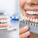 Are Porcelain Veneers Worth It? Cost, Lifespan, and Who Is a Good Candidate