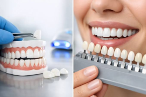 Are Porcelain Veneers Worth It? Cost, Lifespan, and Who Is a Good Candidate