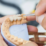 CEREC Crowns vs. Lab Crowns: Understanding the Difference