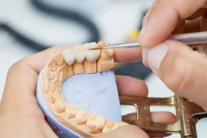 CEREC Crowns vs. Lab Crowns: Understanding the Difference